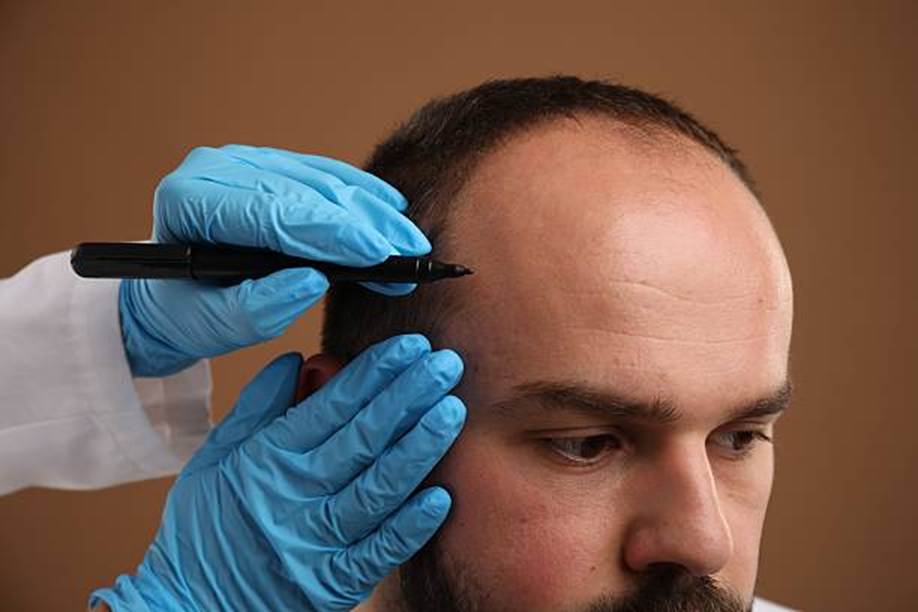 FUE hair transplant